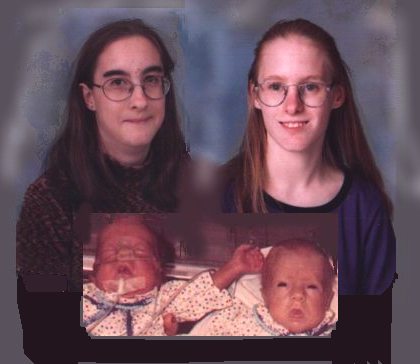 preemies as babies and then teens