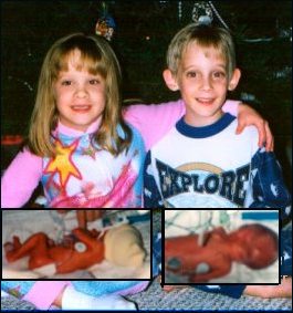 preemies: as babies and as children